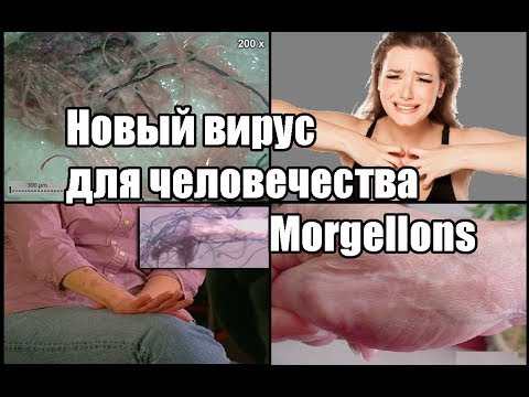 Video: Mysteriet Med Morgellons Sykdom - Alternativt Syn