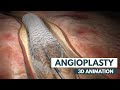 Angioplasty 3d animation  real footage