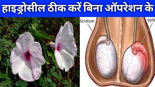 हाइड्रोसील का घरेलू इलाज हाइड्रोसील की सूजन ठीक करें बिना ऑपरेशन के || hydrocele ka ilaaj