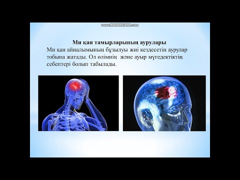 Бердибаева М.А. "Ми қан айналымының өткінші бұзылыстары" Пәні: Неврология