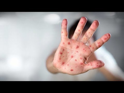 Measles could wipe out parts of immune system, according to new study