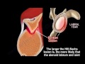 Shoulder dislocation , Hill Sachs Lesion Everything You Need To Know Dr. Nabil Ebraheim