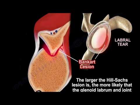 Shoulder dislocation  , Hill Sachs Lesion   - Everything You Need To Know - Dr. Nabil Ebraheim