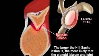 Shoulder dislocation  , Hill Sachs Lesion   - Everything You Need To Know - Dr. Nabil Ebraheim