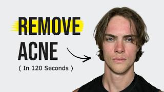 How to Get Rid of Acne ( Explained in 120s )