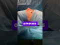 تجميل_الانف - ultrasonicrhinoplasty