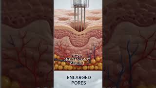 Microneedling Explained: How It Removes Acne Scars, Wrinkles & Open Pores