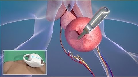 MKT1460A - Magnetic Surgery in a prostatectomy procedure (prostate removal)