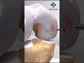 TKR Surgery Open होती है या Arthroscopy से होती है Total Knee Replacement Knee Surgery