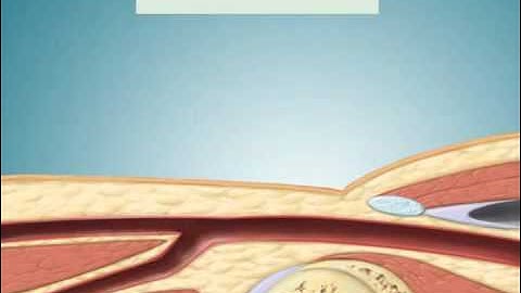 Seldinger technique for Catheterization via Femoral Artery