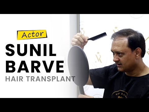 Sunil Barve Hair Transplant Journey | New Roots Hair Transplant |