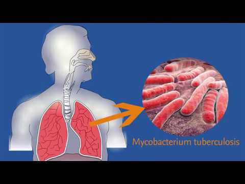 TUBERCULOSIS