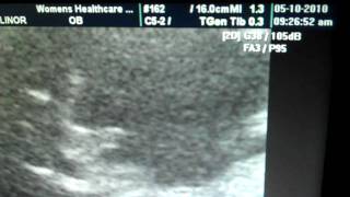 Beautiful Placenta MP4