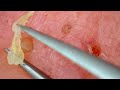 0299 keratin plug removal nose