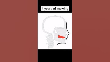 Mewing transformation #mewing #transformation #viral#shorts