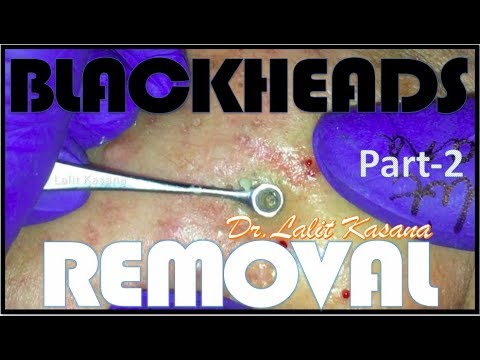 BIG BLACKHEAD REMOVAL/ANTI-ACNE TREATMENT PART-