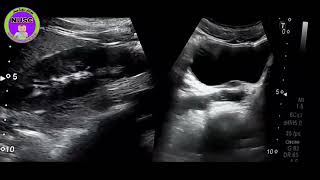 Non-Obstructing Ureterine Stone | signs and symptoms | causes |ultrasound