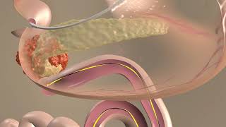 EUS guided gastroenterostomy - steps