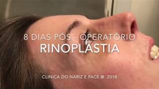 RINOPLASTIA POS-OPERATORIO