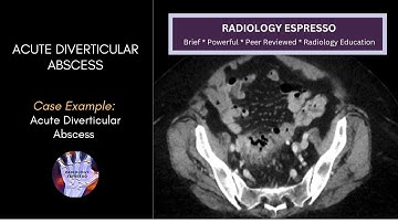 ACUTE DIVERTICULITIS: Case Example – Acute Diverticulitis with Diverticular Abscess (4720)
