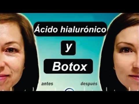 Vídeo: Restylane Vs. Botox: Procedimiento, Resultados Y Comparación De Costos