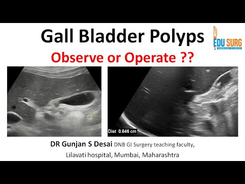 سلائل المرارة متى ت جرى الجراحة خوارزمية علاج م حدثة دليل جراحي قائم على الأدلة