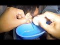 Removing Earwax Debris from Man&#39;s Ear