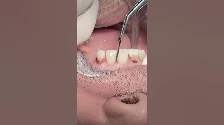Composite veneer for anterior teeth 🦷 #dentist