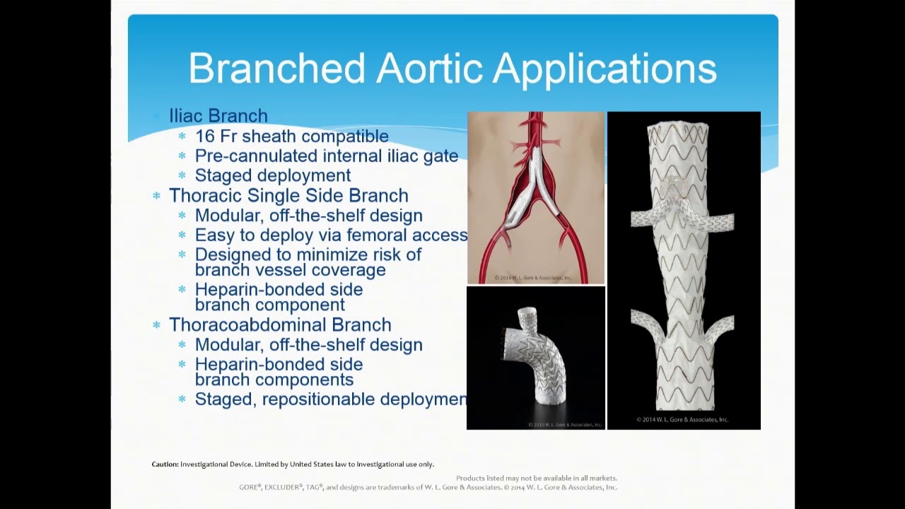 Snorkels, Periscopes, and Fenestrated Devices for Complex EVAR - J. Michael Bacharach, MD