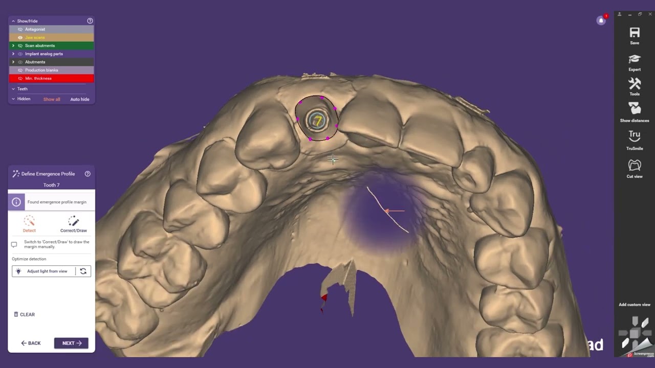 exocad® Tutorial: Design an Angled Screw Channel Custom Abutment