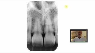 Area of upper anterior teeth. screenshot 5