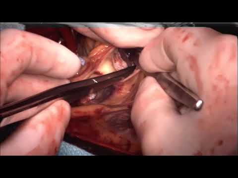 Extended Septal Myectomy (Graphic)