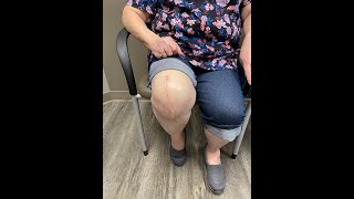 6 Week Follow Up and Doing Great | Robotic (MAKO) Right Total Knee Replacement by Dr. Robert Cagle