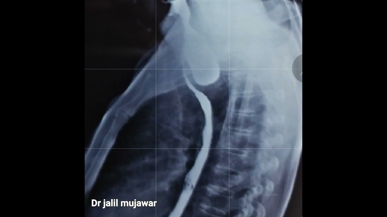 oesophageal diveruculum. zenkers diverticulum. dr jalil mujawar.