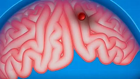 ¿Cómo afecta la trombosis al cerebro?