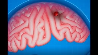 Venosa definicion trombosis cerebral