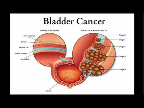 Blasenkrebs: Ursachen, Symptome, Risikofaktoren und Medikamente.