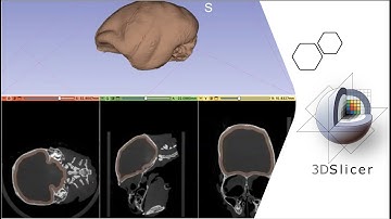 HOW TO:  Use the "Hollow" Tool    [3D Slicer Workflow]