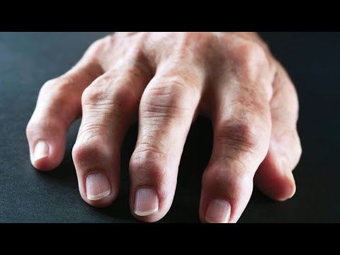 Подагра пальцев рук фото и лечение