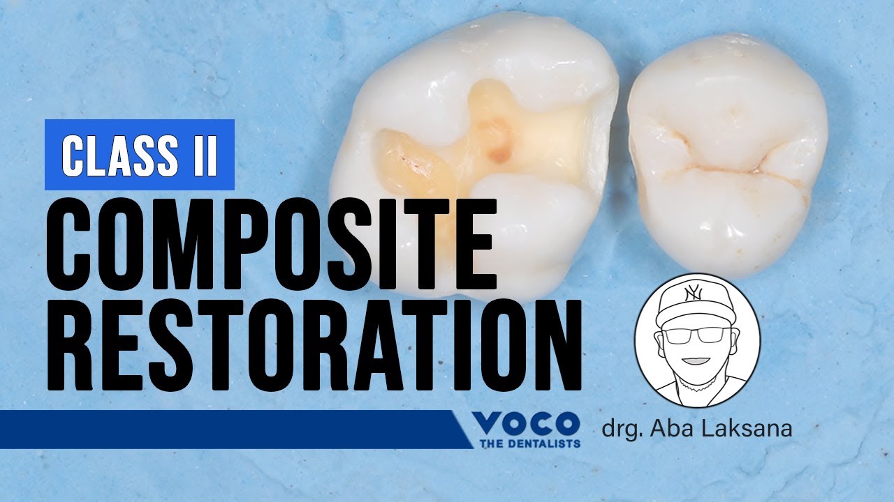 Posterior Restoration Class II Direct Composite Resin | Polofil Supra (Micro-hybrid Composite) VOCO