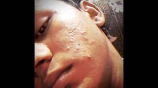 #acnetreatment #skincaretips #acnehelp