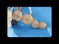 RCT of 46,Post Endodontic Restoration with Emax Overlay#rct #postendo#restorations #overlay #ceramic