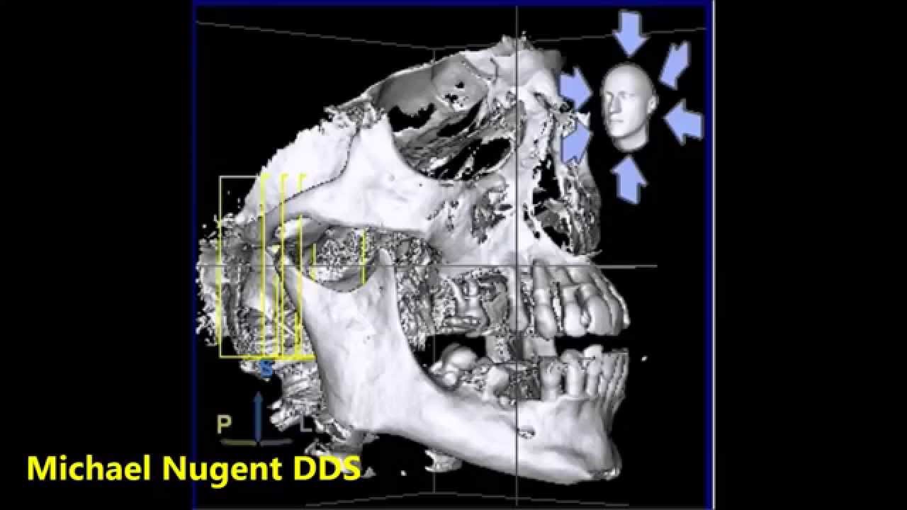 Cone Beam | Pasadena Texas Dentist | 77504 - YouTube