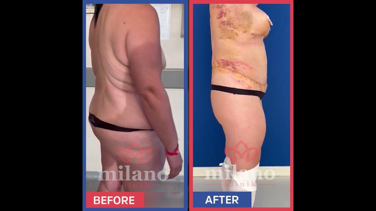 360 Liposuction + FDL Tummy Tuck Before After in Turkey YouTube