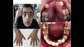 Underdeveloped or absent collarbones Delayed closure of skull sutures and fontanelles soft spots screenshot 4