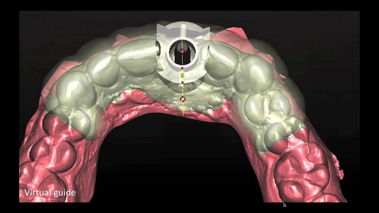 Best Implant Flap Design PART 1 YouTube