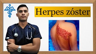 Herpes zóster