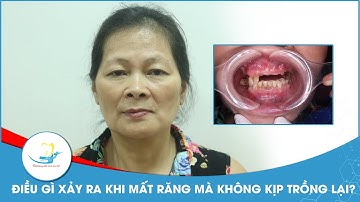 Điều gì xảy ra khi mất răng mà không kịp trồng lại?