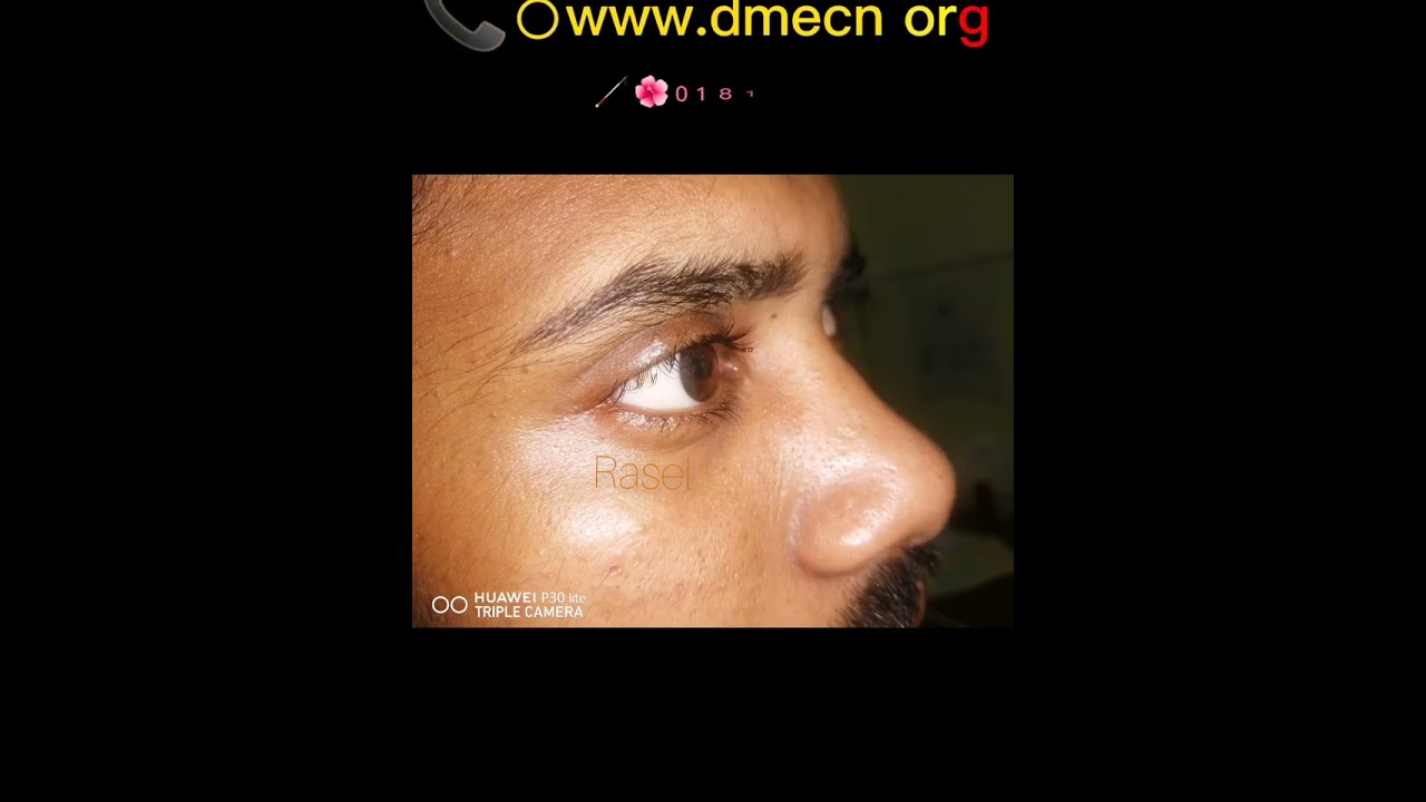Artificial eye in Bangladesh, Artificial eye, কৃত্রিম চক্ষু সংযোজন,  Eye Hospital