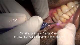 Thumbnail of Laser Treatment for Oral submucous Fibrosis Part 1 :Zolar Dental Diode Laser